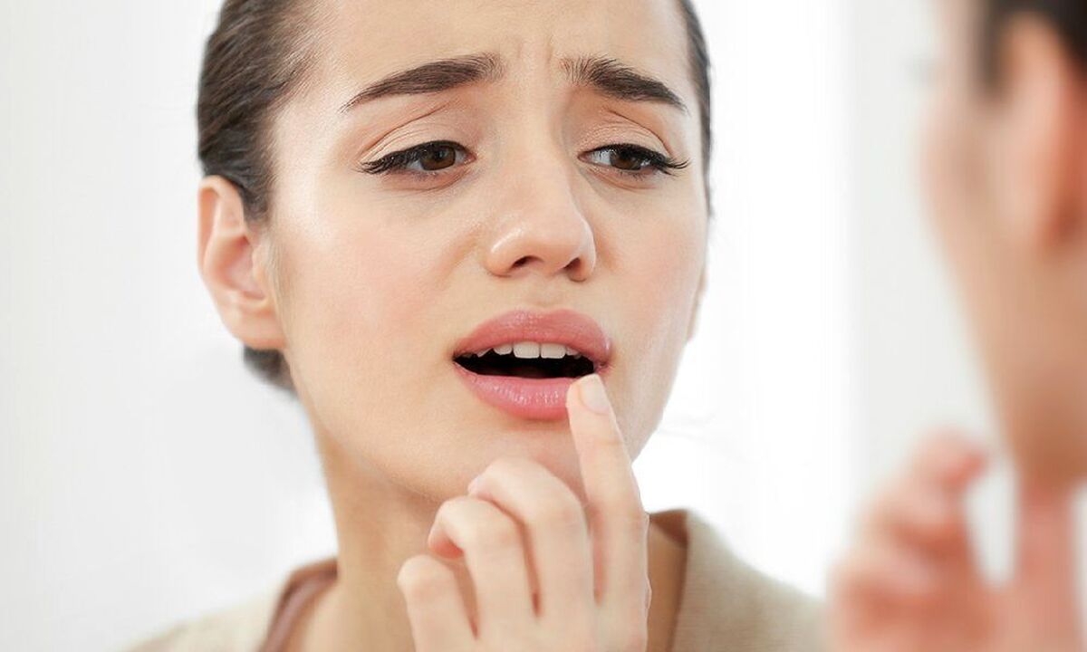 آفت دهان را چگونه از بین ببریم؟