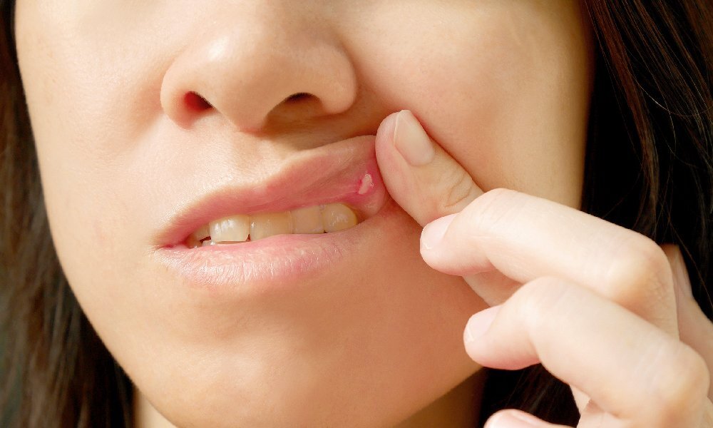 آفت دهان را چگونه از بین ببریم؟