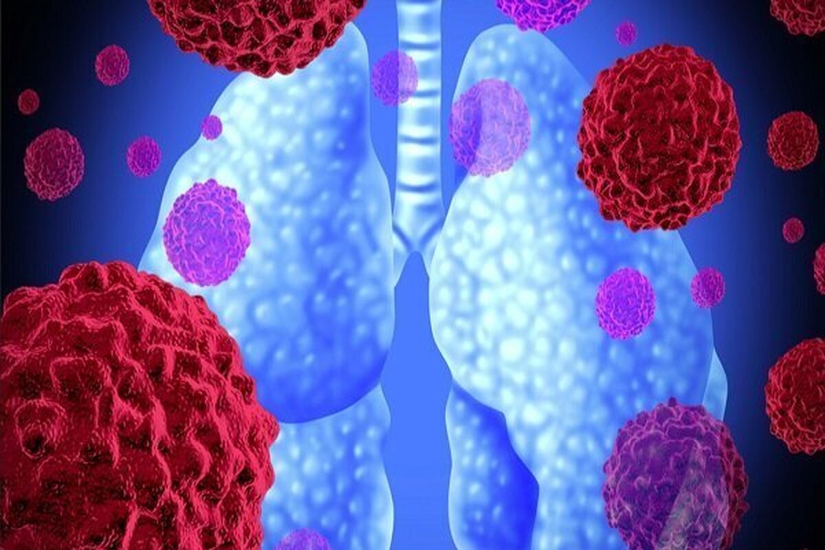 تشخیص زودهنگام سرطان ریه چگونه ممکن است؟