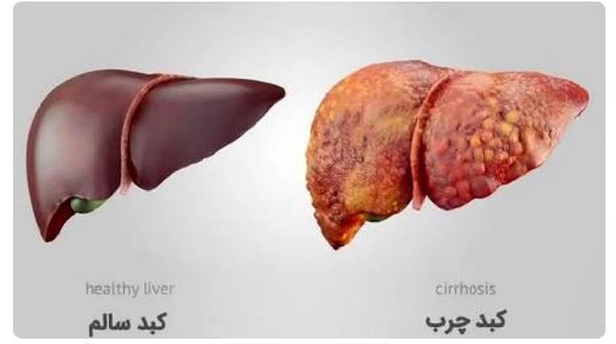کاهش خطر ابتلا به کبد چرب غیرالکلی با پروتئین‌های گیاهی