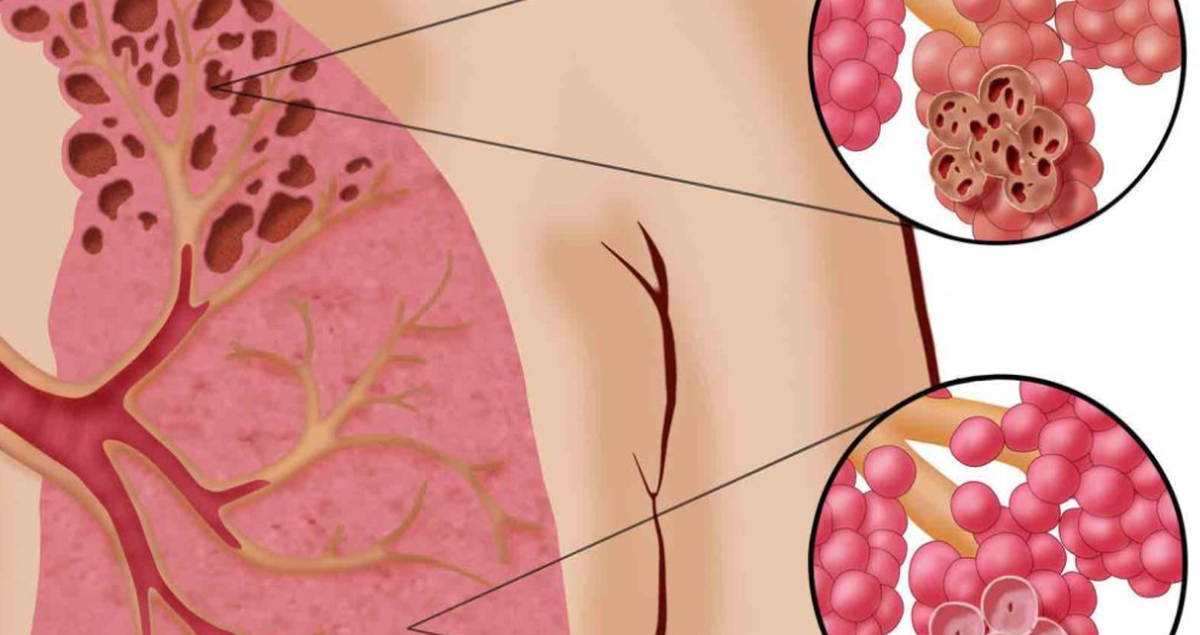 چه درمانی برای سرطان ریه وجود دارد؟