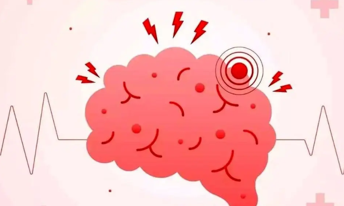 چگونه احتمال سکته مغزی را کاهش دهیم؟