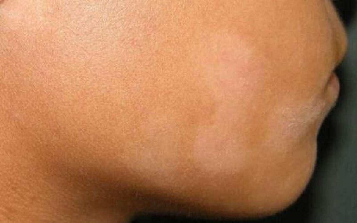 آیا بوجود آمدن لکه‌های سفید روی بدن کودکان خطرناک است؟