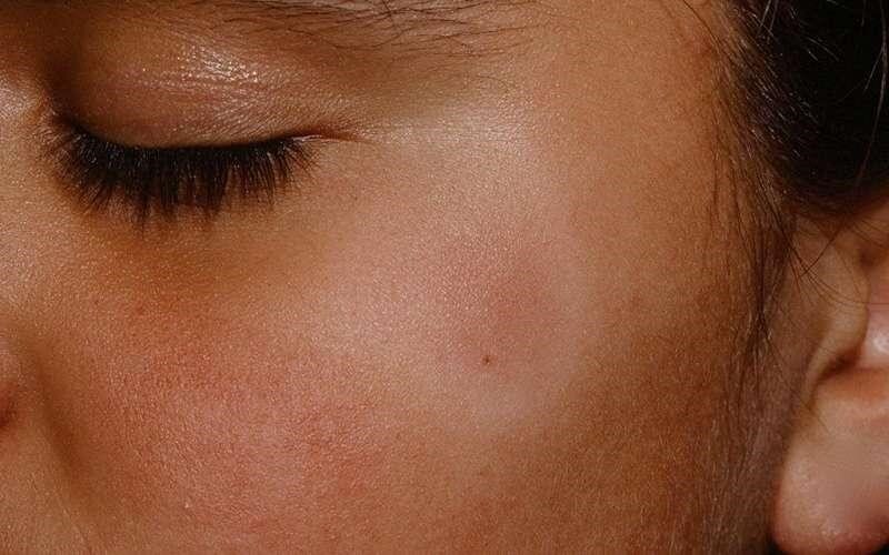 آیا بوجود آمدن لکه‌های سفید روی بدن کودکان خطرناک است؟
