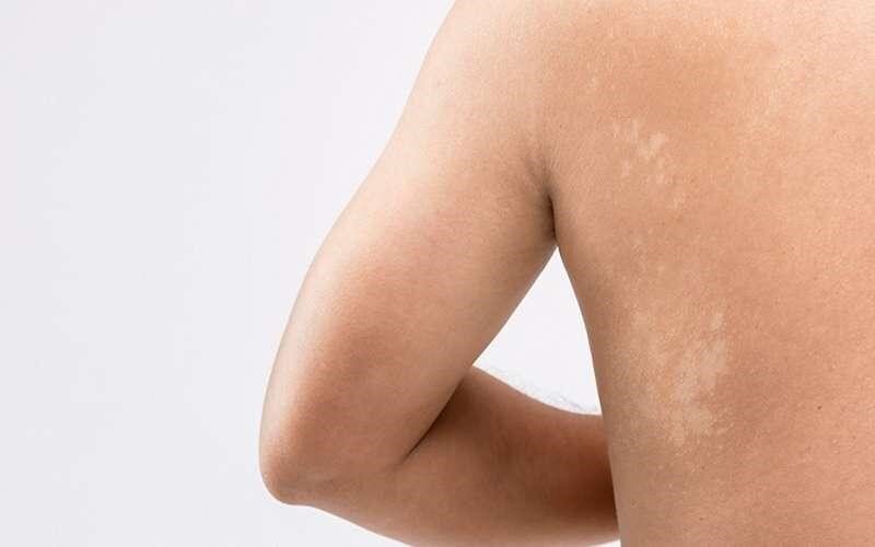 آیا بوجود آمدن لکه‌های سفید روی بدن کودکان خطرناک است؟