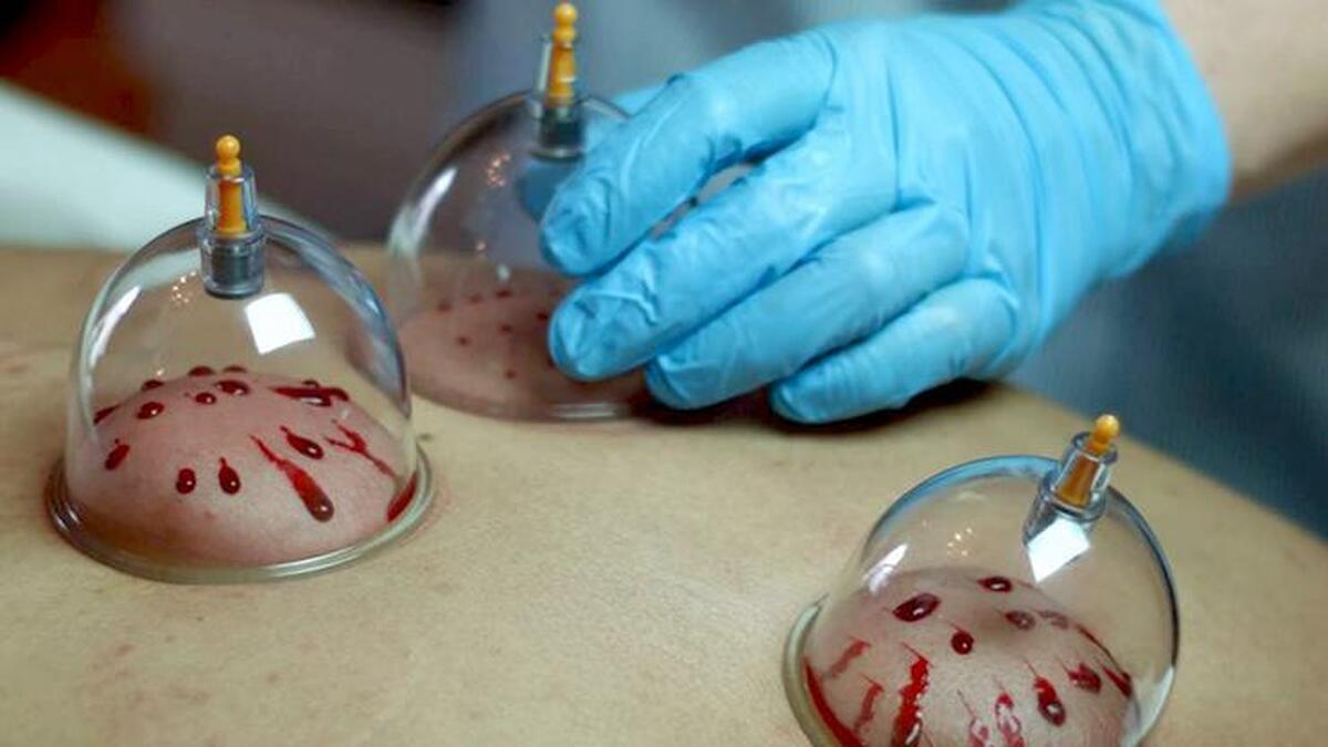 فصل تابستان بهترین زمان برای انجام حجامت!