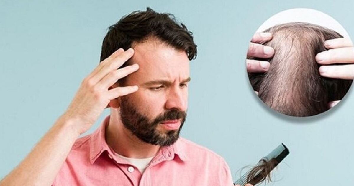 چرا مو‌ها به صورت سکه‌ای ریزش دارند؟