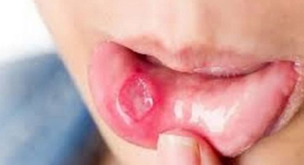 از این زخم به ظاهر بی خطر دهان به سادگی عبور نکنید