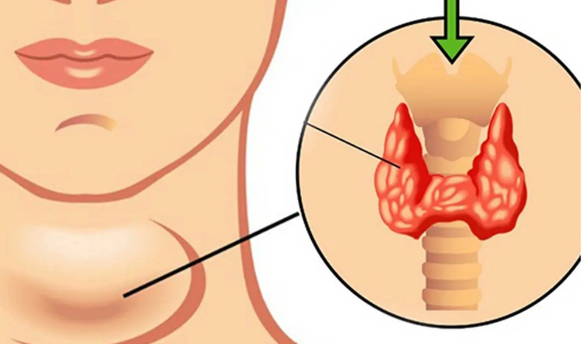 کم‌کاری تیروئید چه تاثیری بر هورمون‌ها دارد؟