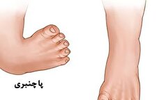 علت و روش درمان ناهنجاری استخوان‌ها و پا چنبری چیست؟