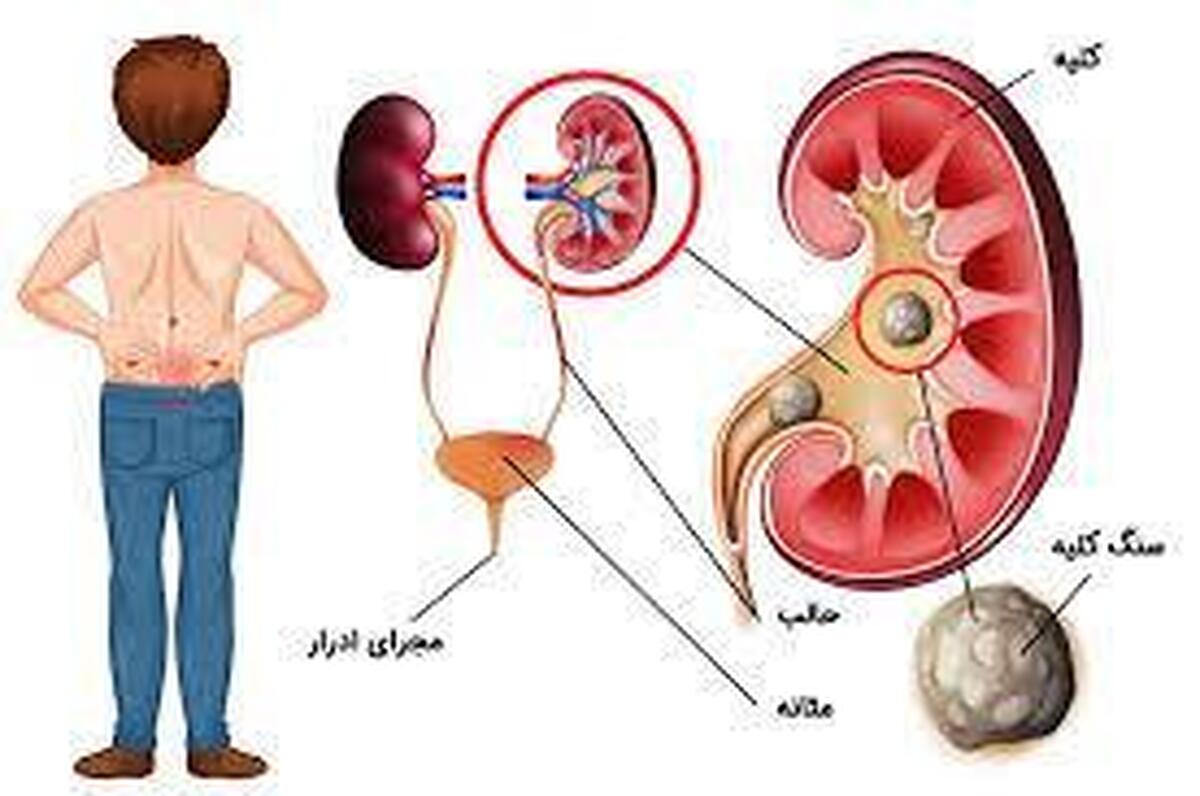 تغذیه میتواند مانع ابتلا به سنگ کلیه شود؟