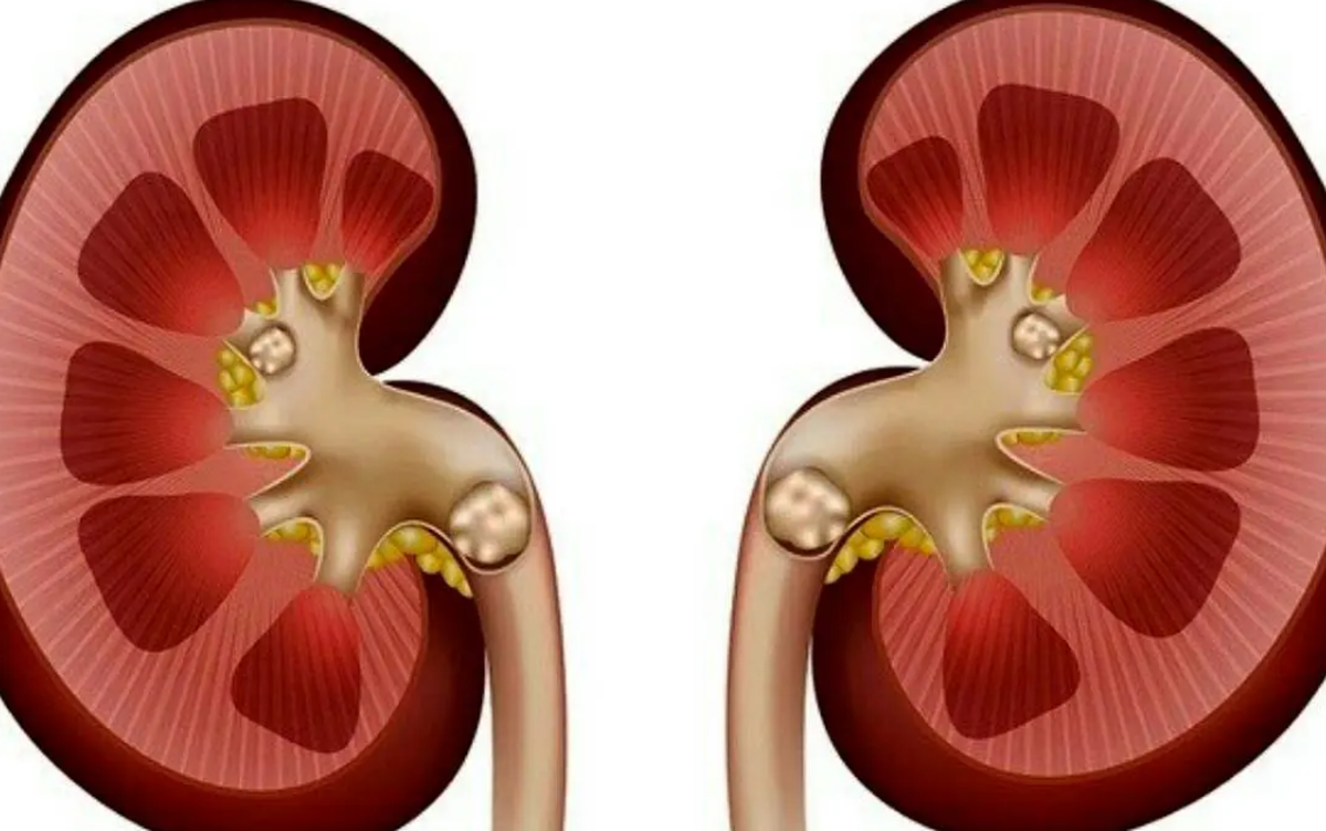 علائم شایع سنگ کلیه چیست؟ + راه‌های پیشگیری
