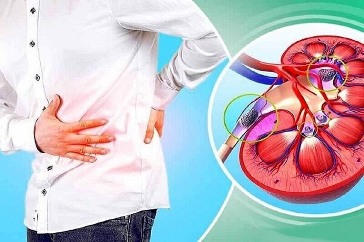 چرا بیماری سنگ کلیه شیوع پیدا کرده است؟ +راه پیشگیری و درمان