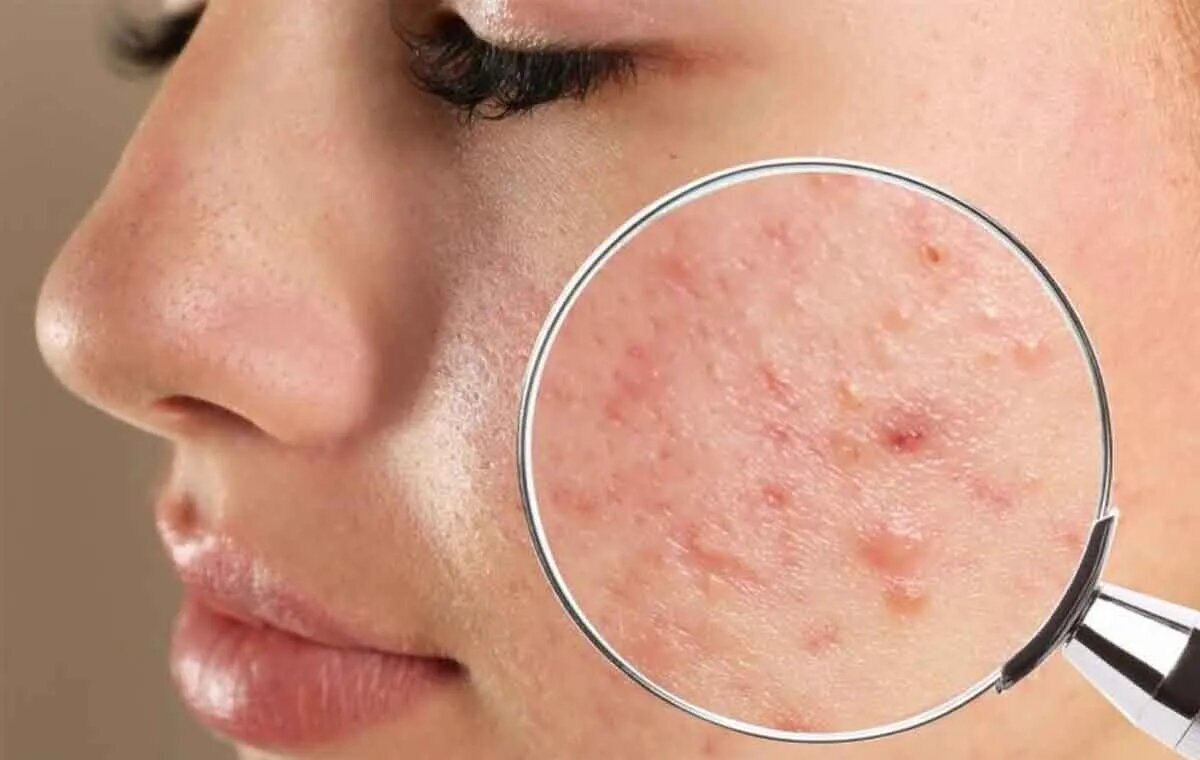 اگر از جوش‌های چرکی روی صورت خود خسته شده‌اید بخوانید!