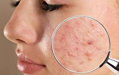 اگر از جوش‌های چرکی روی صورت خود خسته شده‌اید بخوانید!