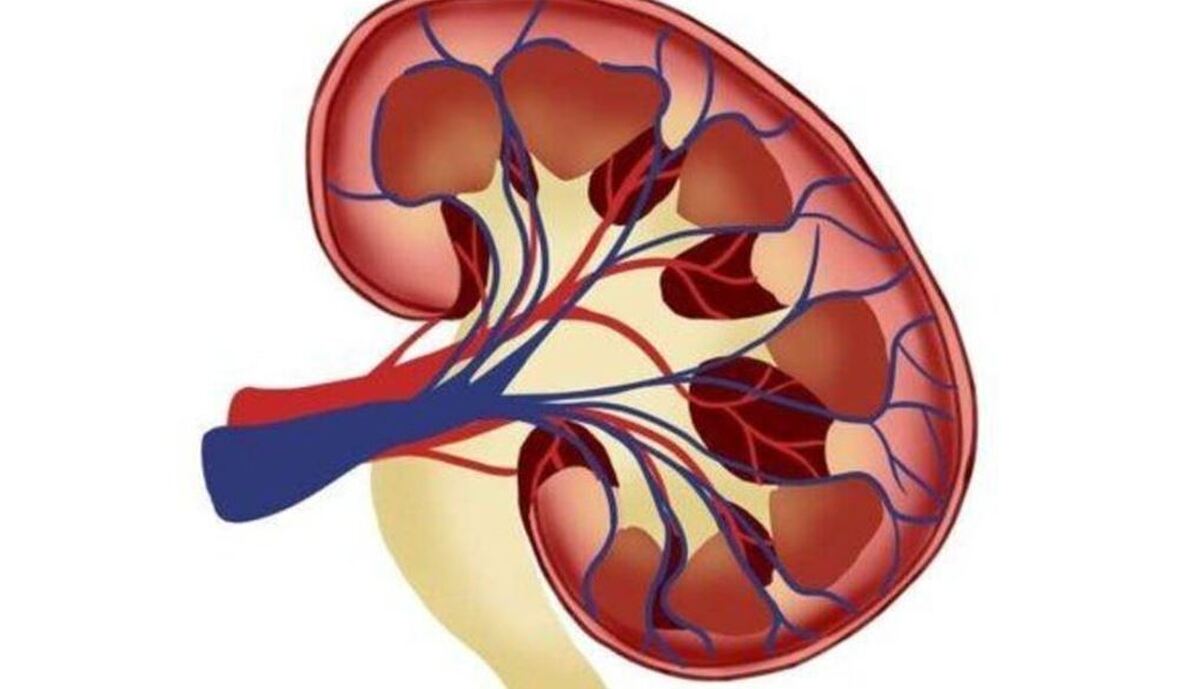 پاسخ مهم‌ترین پرسش‌ها درمورد سنگ کلیه