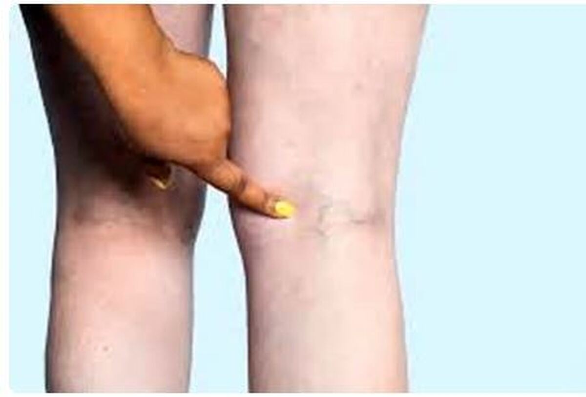 چگونه از ابتلا به واریس پیشگیری کنیم؟