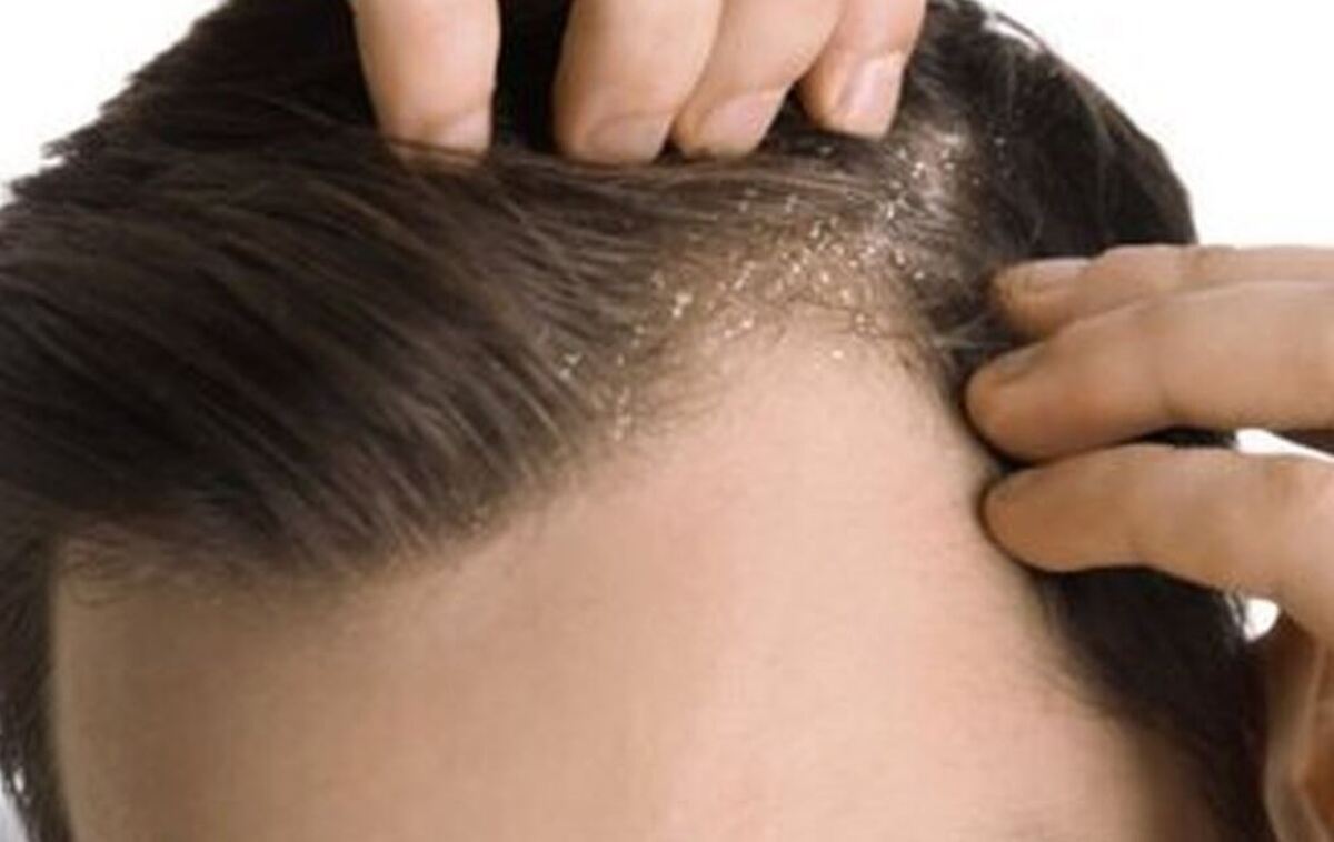 شوره سر را چگونه درمان کنیم؟