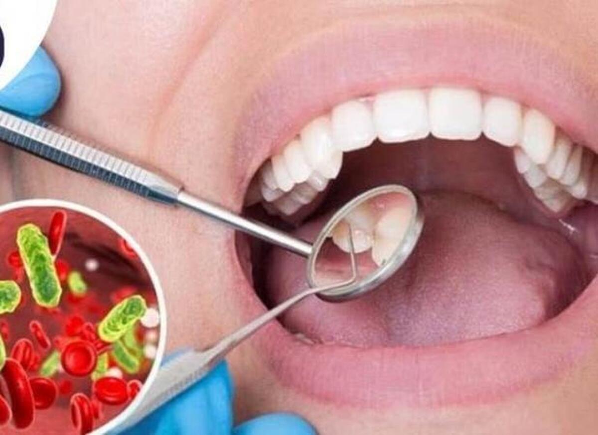عفونت ریشه دندان کامل درمان میشود؟