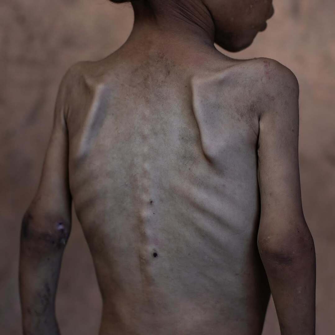عکس‌| غزه در حال مرگ است: شهادت‌های هولناک از قحطی و شرایط فاجعه‌بار در میان سکوت جهانی
