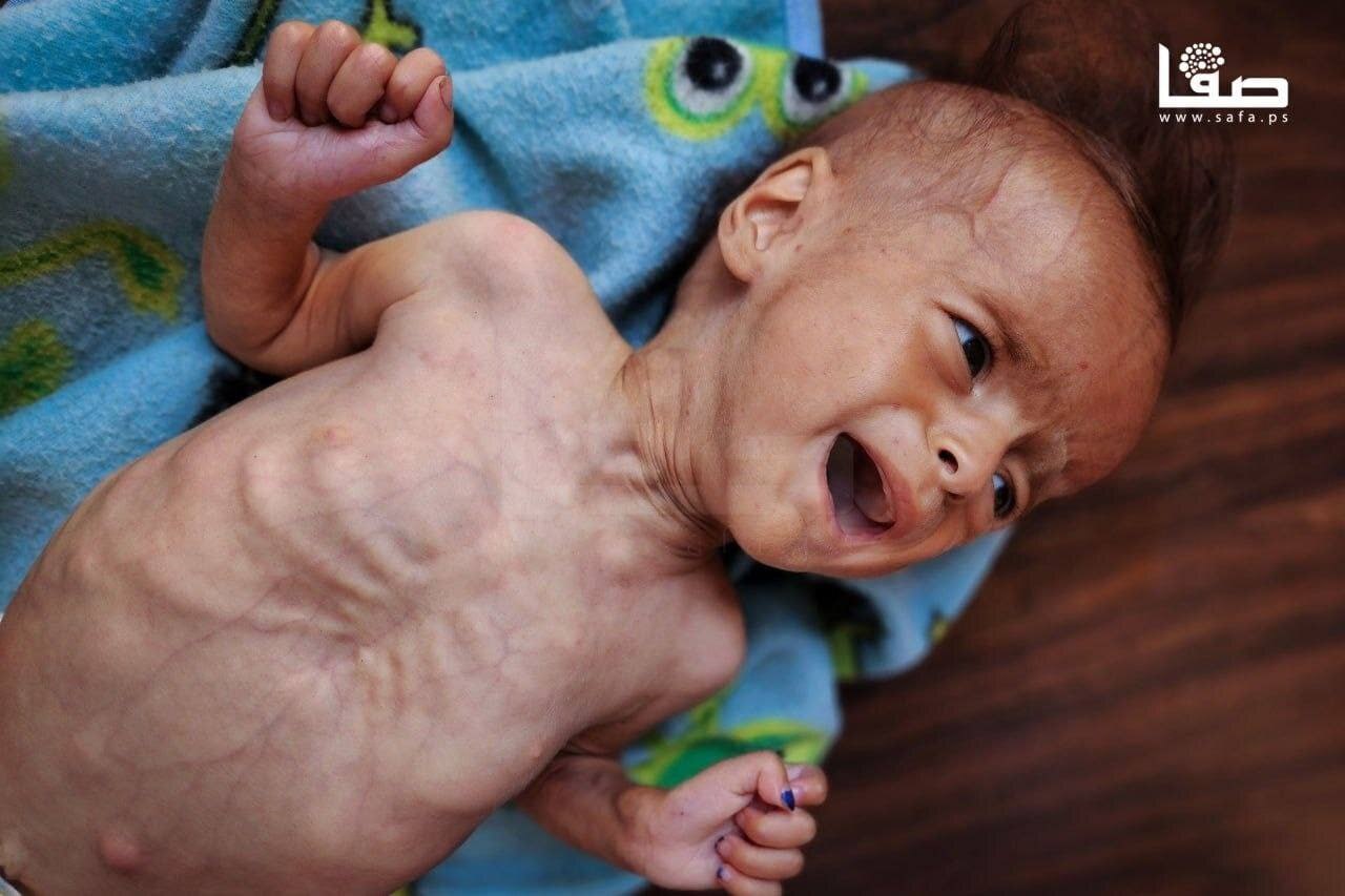 عکس‌| غزه در حال مرگ است: شهادت‌های هولناک از قحطی و شرایط فاجعه‌بار در میان سکوت جهانی