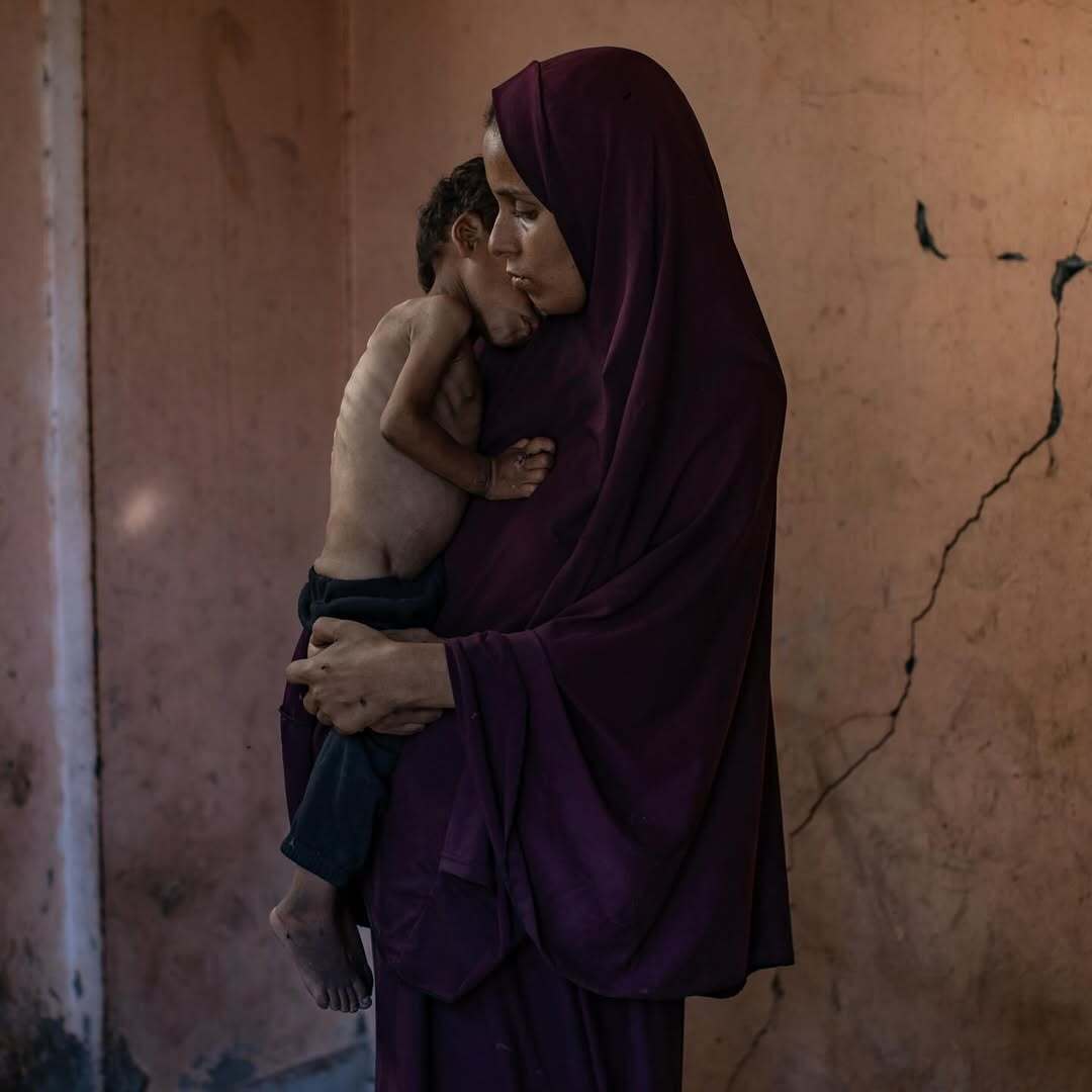 عکس‌| غزه در حال مرگ است: شهادت‌های هولناک از قحطی و شرایط فاجعه‌بار در میان سکوت جهانی