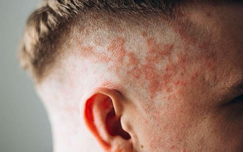 آشنایی با اگزمای پوست سر +روش‌های درمانی