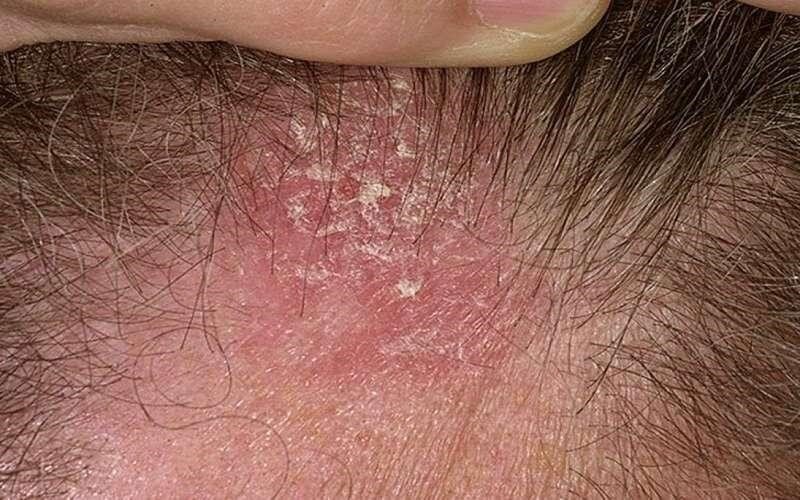 آشنایی با اگزمای پوست سر +روش‌های درمانی