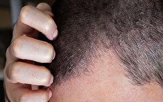 آشنایی با اگزمای پوست سر +روش‌های درمانی