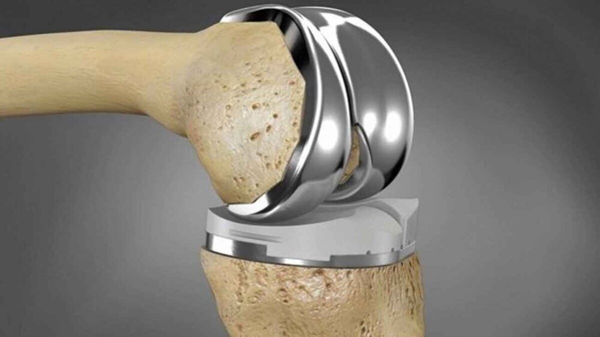 دوره ایمپلنت‌های فلزی دائمی به پایان رسید!