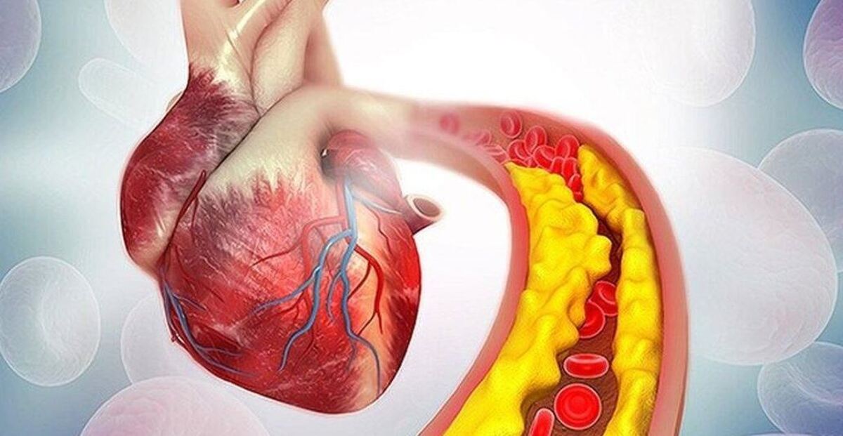 مضرترین غذا‌ها برای چربی خون را بشناسید