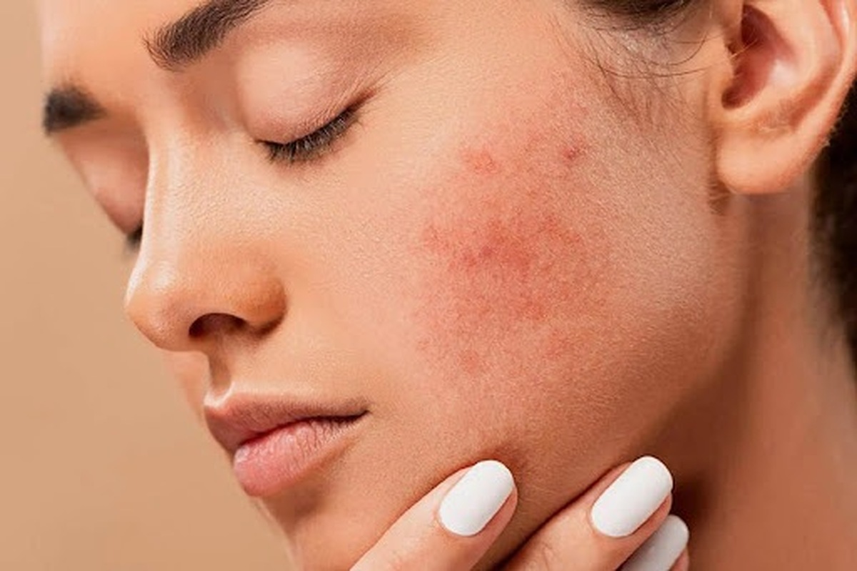 ۱۰ نکته برای تسکین علائم آفتاب سوختگی