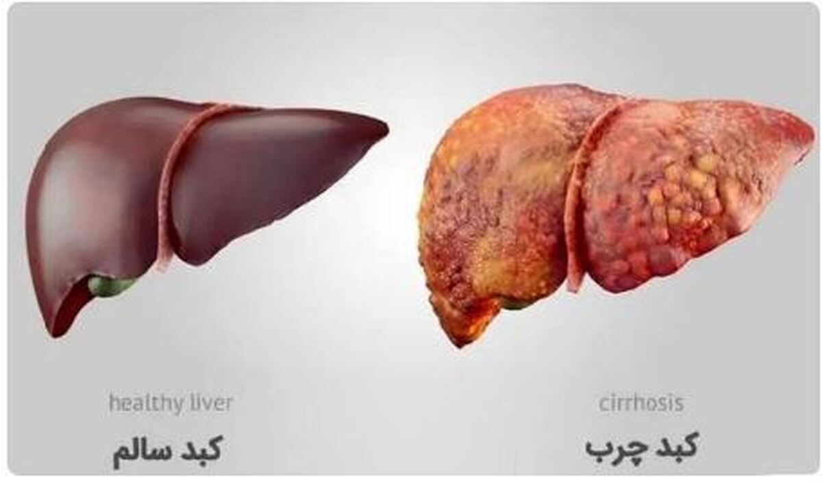 تغذیه و سبک زندگی سالم؛ راه خلاصی از کبد چرب