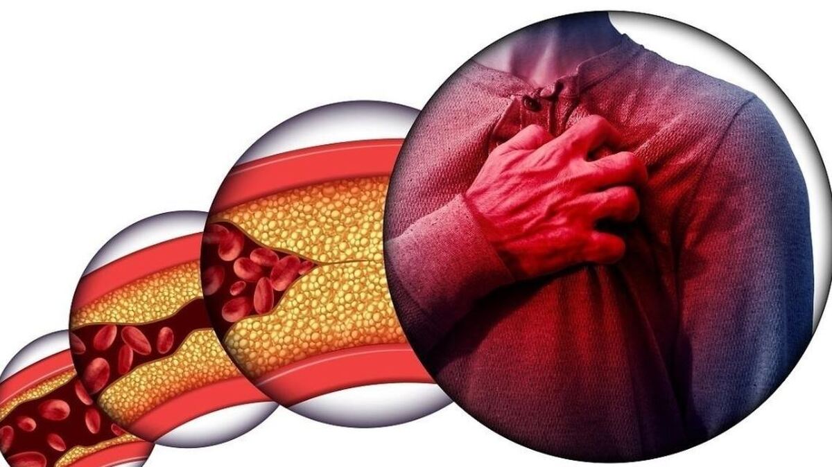 چربی خون بالا و کنترل نشده زمینه ساز چه بیماری‌هایی می‌شود؟