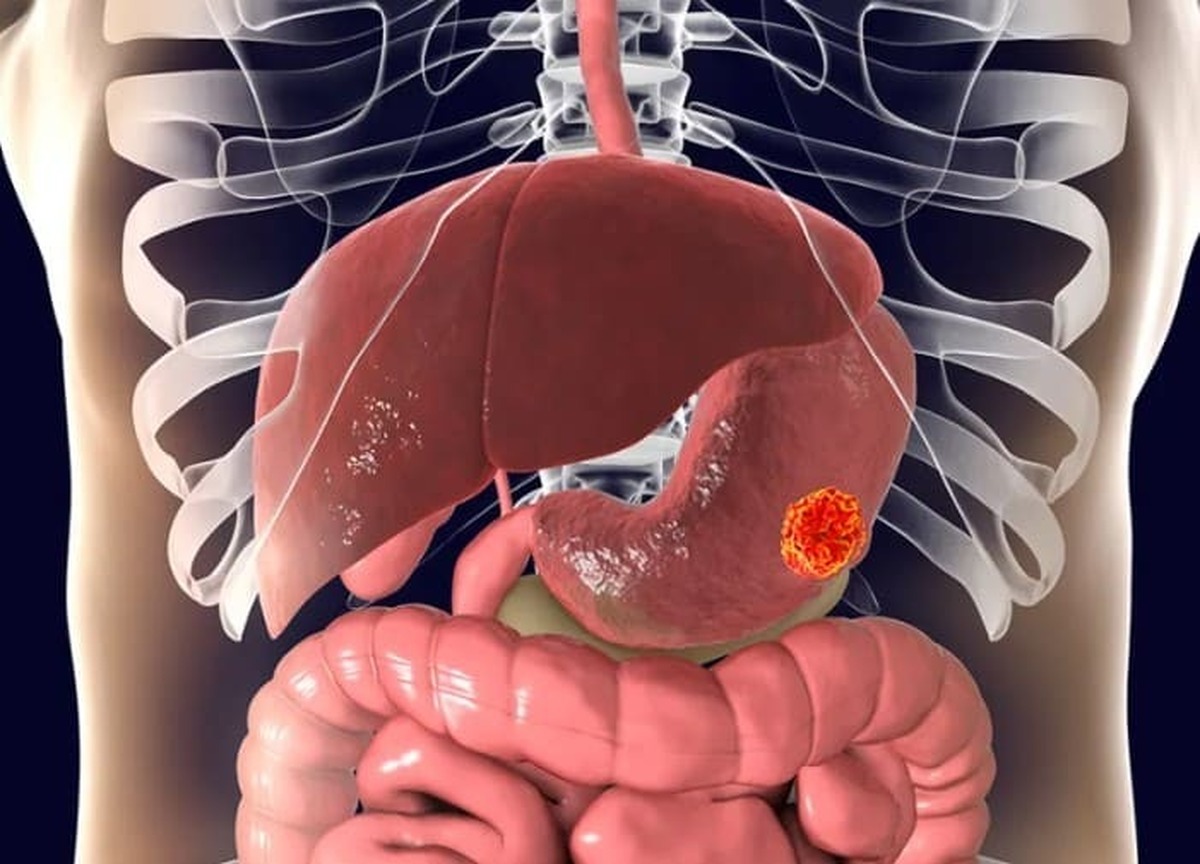 سرطان معده ممکن است توسط باکتری‌ای ایجاد شود که در بدن نیمی از مردم کره زمین یافت می‌شود