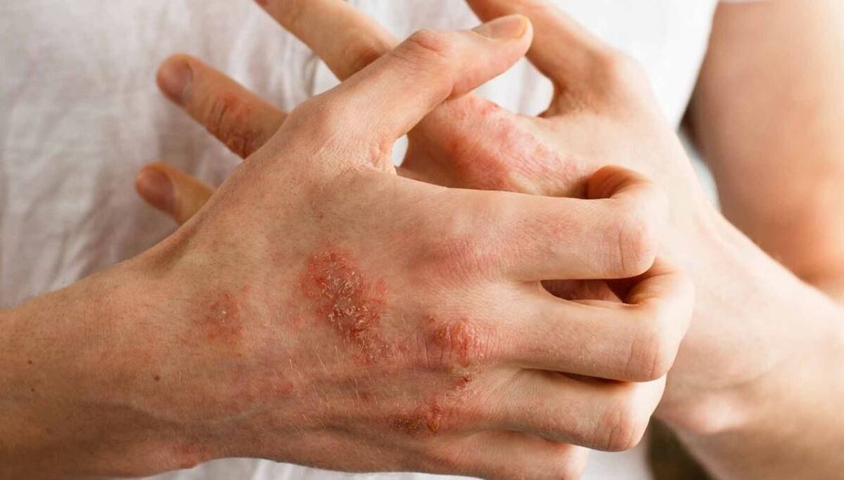 چگونه اگزما را در خانه درمان کنیم؟
