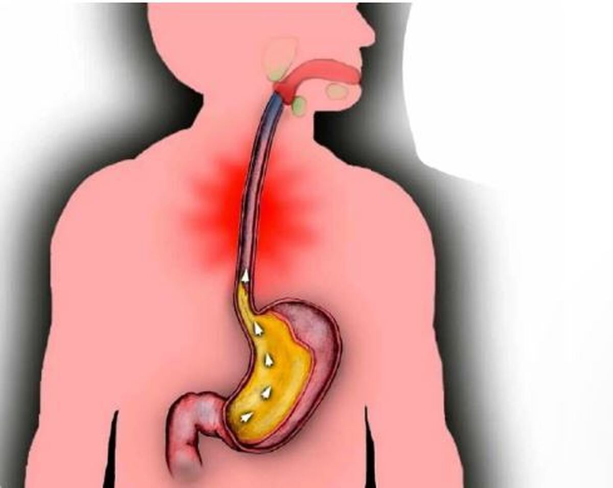 معرفی غذا‌های ضد اسید برای افرادی که درگیر رفلاکس معده هستند