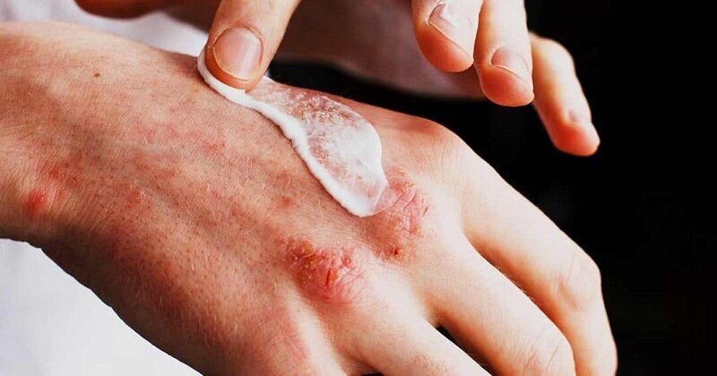 درماتیت آتوپیک چیست و چرا به آن مبتلا می‌شویم؟