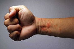 درماتیت آتوپیک چیست و چرا به آن مبتلا می‌شویم؟