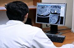 علائم نامحسوس میکروسکته مغزی