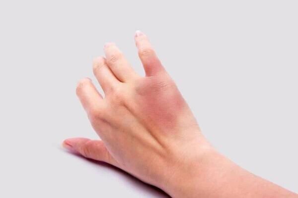 تغییر رنگ کبودی بدن به چه معناست؟ /از قرمز و صورتی تا سبز!