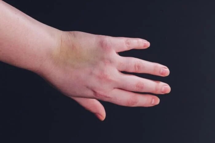 تغییر رنگ کبودی بدن به چه معناست؟ /از قرمز و صورتی تا سبز!