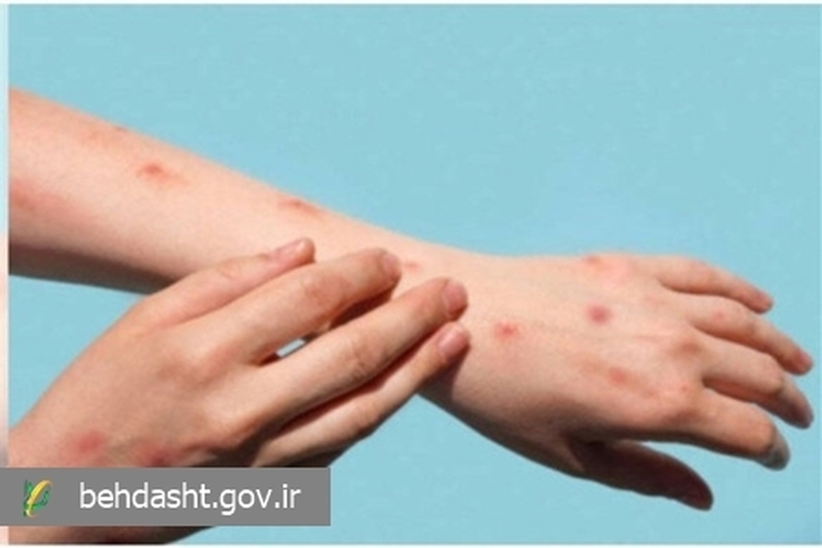 ابتلای بزرگسالان به بیماری آبله‌مرغان چقد متفاوت با کودکان است؟