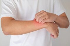 تشخیص زودهنگام؛ ابزار مؤثر در کنترل اگزما