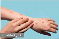 ابتلای بزرگسالان به بیماری آبله‌مرغان چقد متفاوت با کودکان است؟