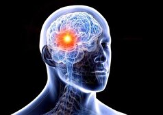 چه دلایلی باعث خون ریزی مغزی می‌شود؟