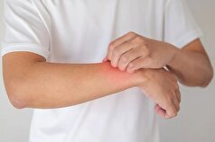 اهمیت تشخیص زودهنگام اگزما در کودکان!