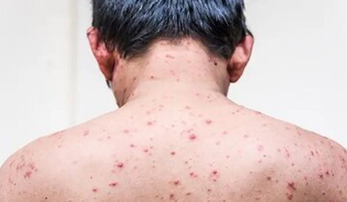مهم‌ترین راه پیشگیری از ابتلا به بیماری آبله‌مرغان چیست؟