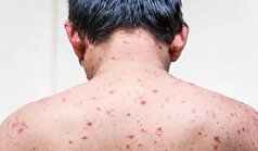 مهم‌ترین راه پیشگیری از ابتلا به بیماری آبله‌مرغان چیست؟
