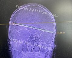 پزشکان روسی مردی را که میخ ۱۲ سانتی‌متری در سرش فرو رفته بود، نجات دادند